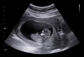 Imbasan Ultrasound 2D — Penilaian Klinikal